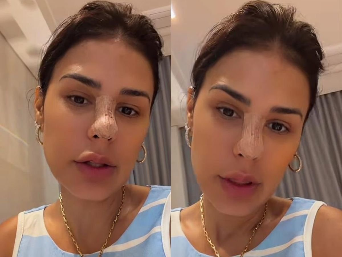 Simone Mendes revela procedimento estético no nariz e desperta curiosidade nas redes sociais